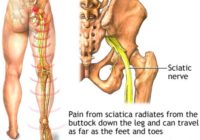 sciatic nerve block pain