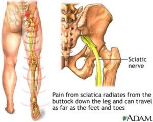 sciatic nerve block pain