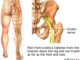 sciatic nerve block pain