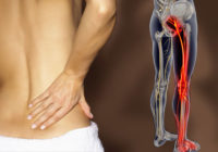 sciatica treatments