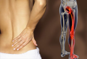 sciatica treatments